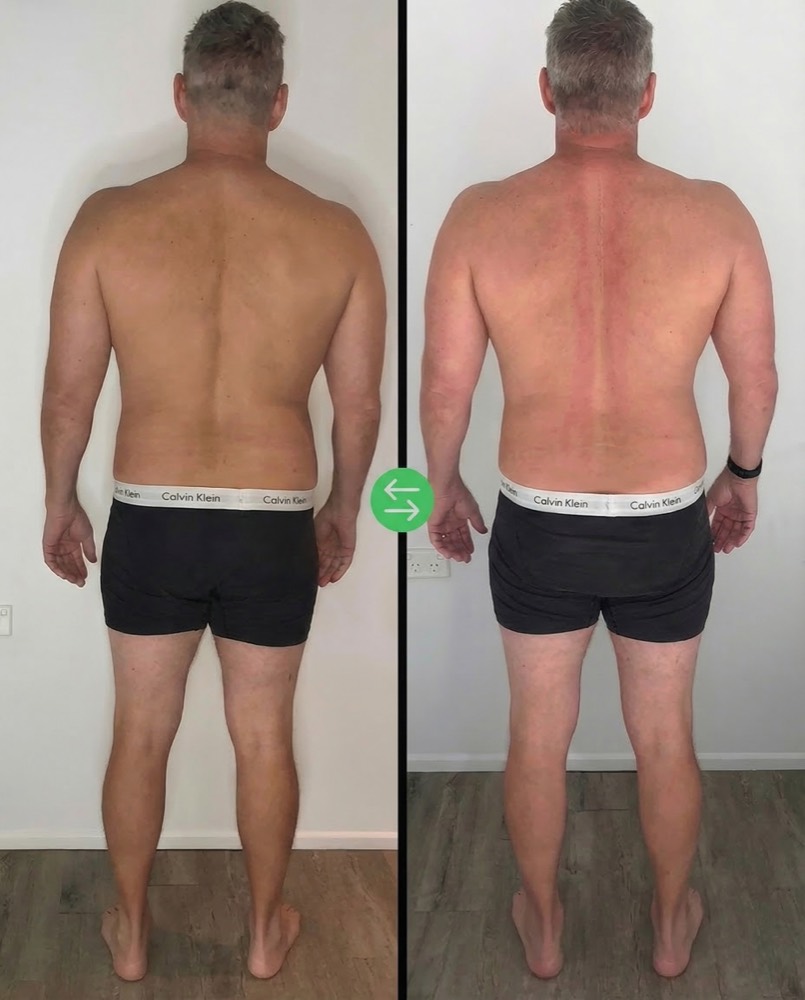 Before and after posture improvement - back view