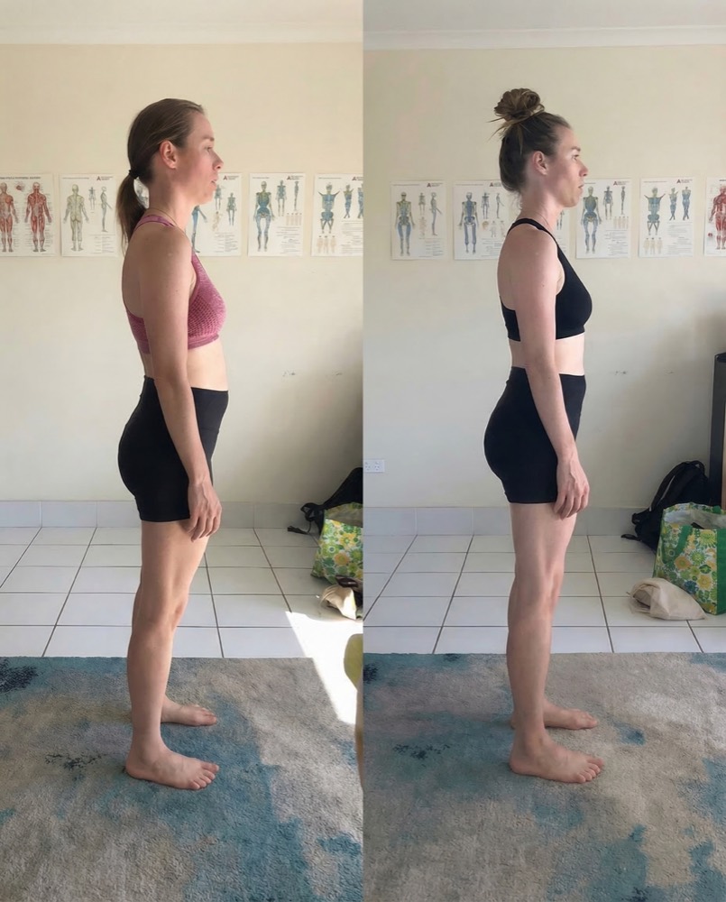 Before and after alignment correction - back view